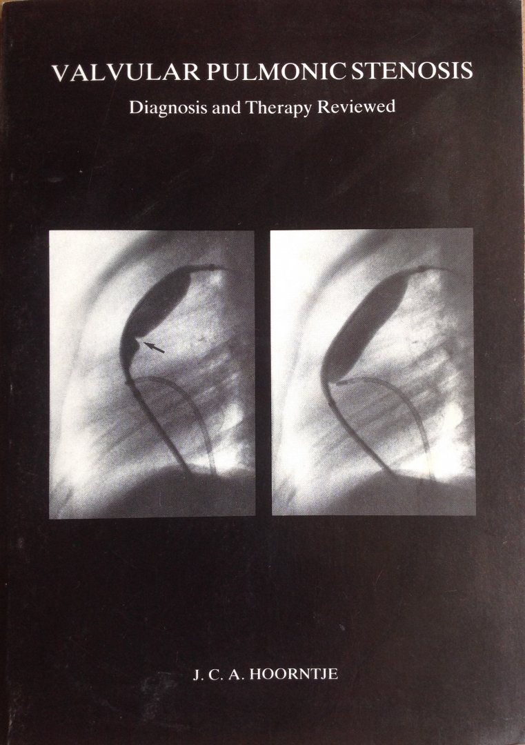Hoorntje, J.C.A. - Valvular Pulmonic Stenosis - Diagnosis and Therapy Reviewed