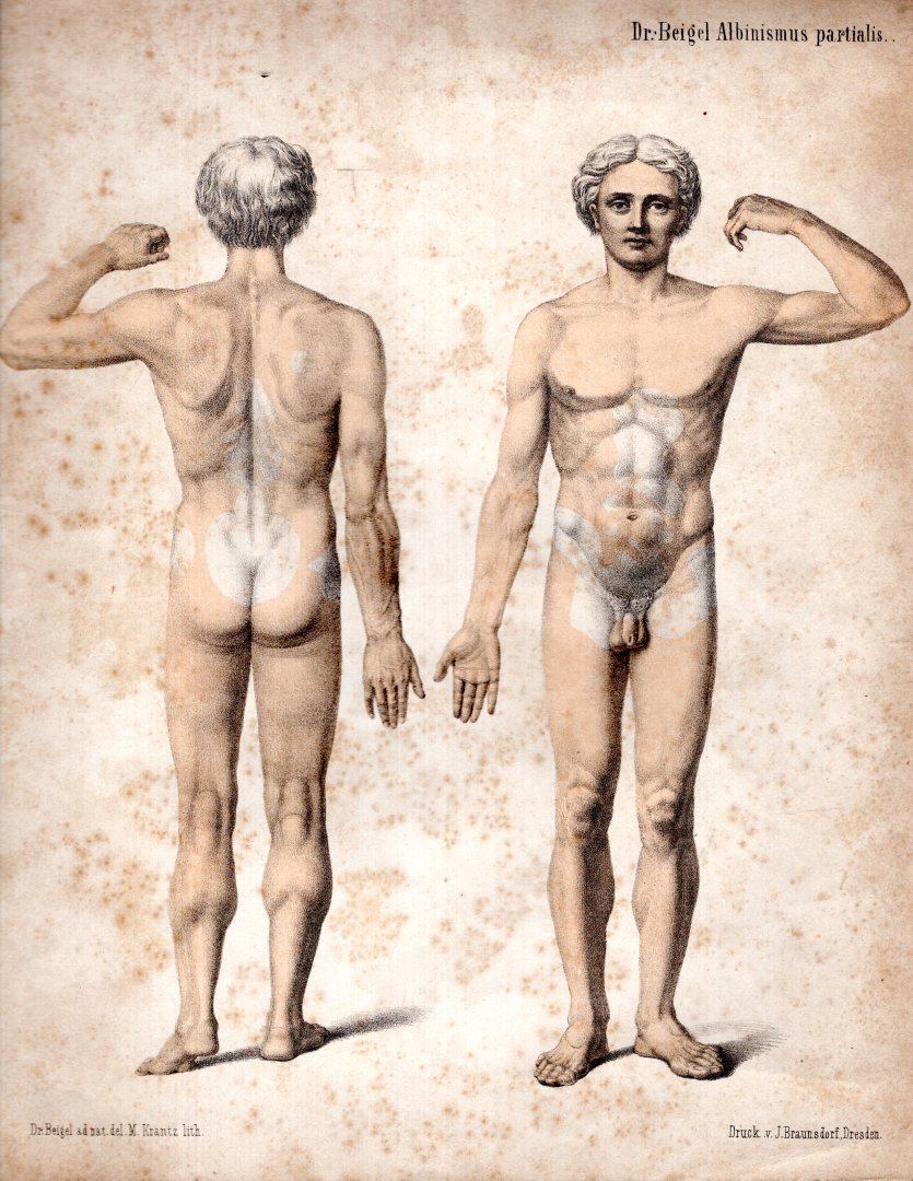 Beigel, Hermann. - Beitrag zur Geschichte und Pathologie des Albinismus partialis und der Vitiligo und über Negrismus