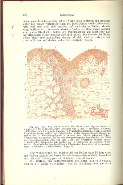 Ziegler, Dr. Ernst Mit 604 teils schwarzen , teils farbigen abbildungen - Allgemeine Pathologie und der Pathologischen Anatomie fur Arzte und Studierende, Erster Bande .. Proffessor der pathologischen anatomie und allgemeinen pathologie an der universitat Freiburg im Breisgau