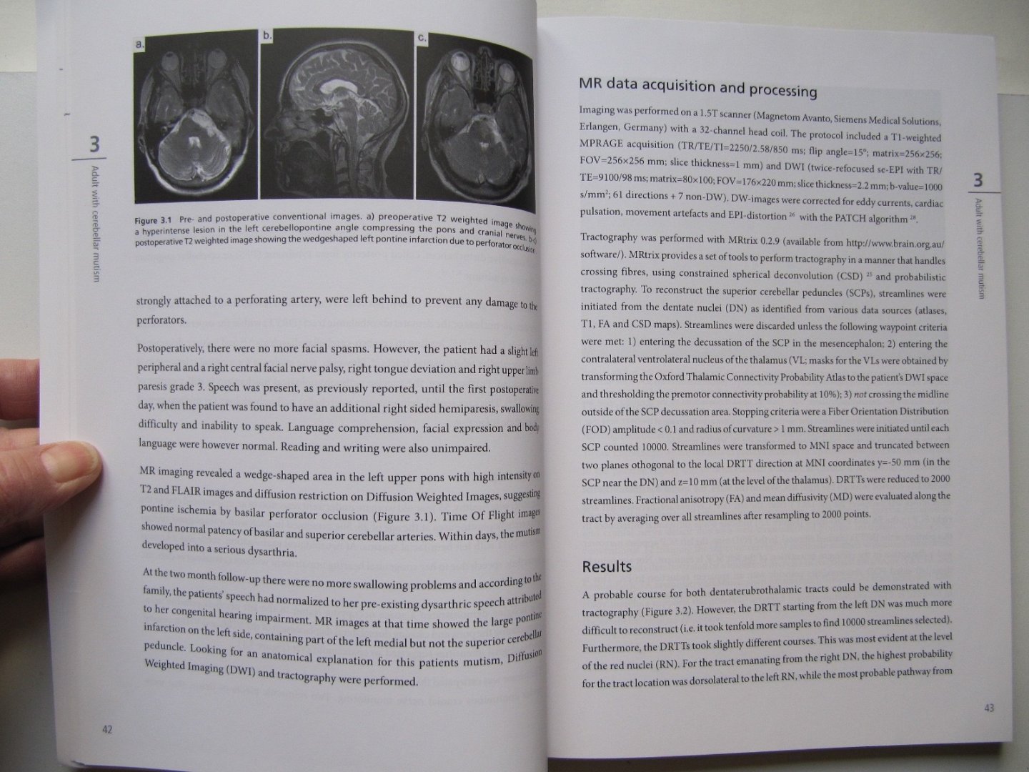 K.M. van Baarsen - The anatomical substrate of cerebellar mutism - Back to basics
