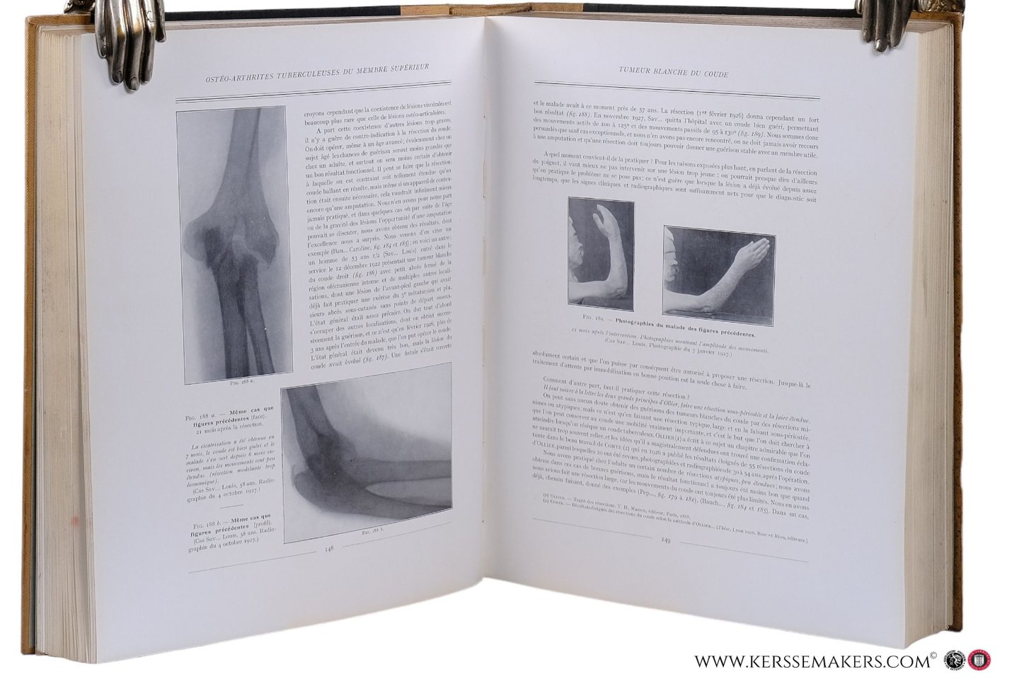 Duval, P. / J. Gatellier / G. Haret / A. Dariaux / Jean Quénu / Etienne Sorrel / Sorrel-Dejerine / and others - Atlas de Radiographie Osseuse. I. Squelette Normal. Deuxième édition. II. Pathologie. I. Lésions Traumatiques. II. Lésions non Traumatiques. [ 2 volumes ] & Tuberculose Osseuse et Ostéo-Articulaire & Radiologie Clinique du Tube Digestif. 1. E...