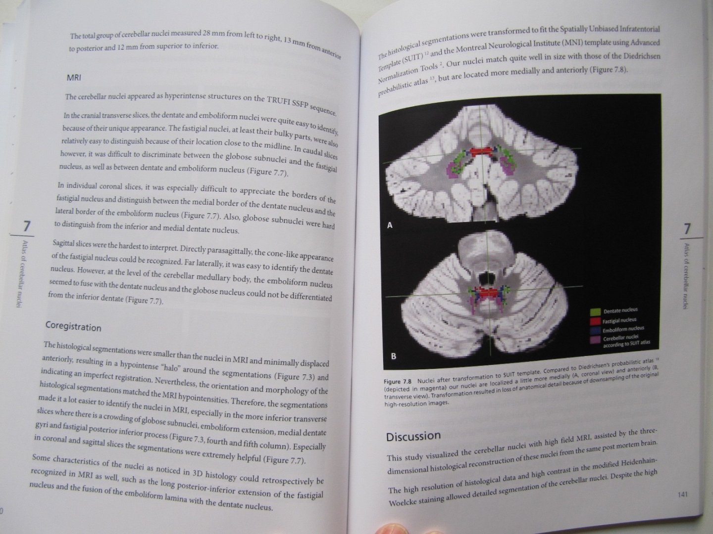 K.M. van Baarsen - The anatomical substrate of cerebellar mutism - Back to basics