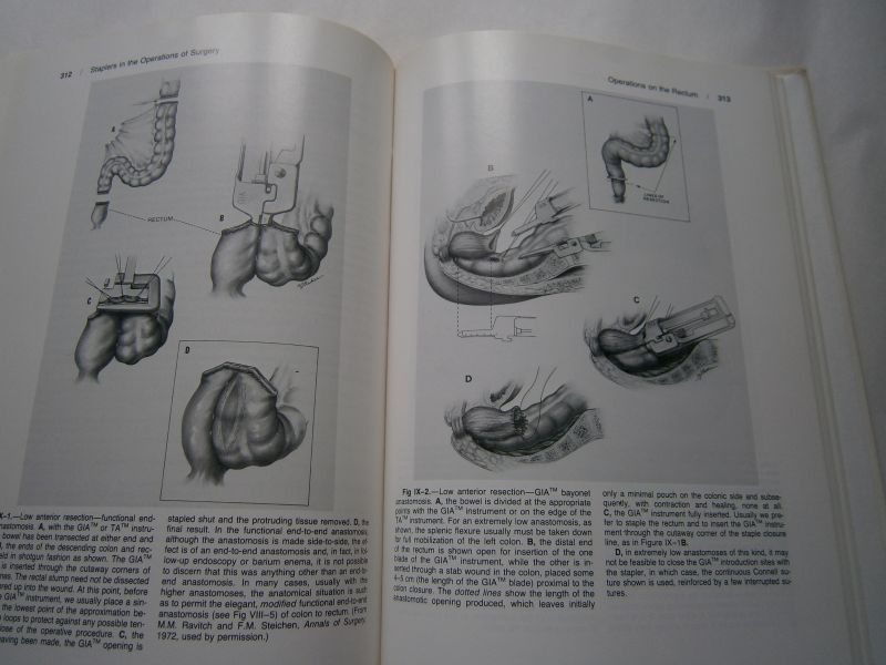 Steichen, F.M. Mark M. Ravitch - Stapling in surgery
