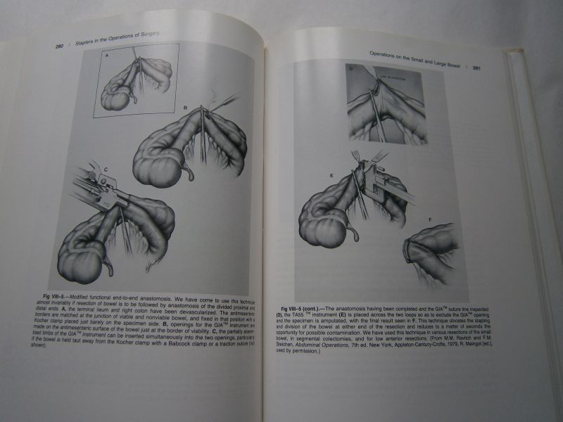 Steichen, F.M. Mark M. Ravitch - Stapling in surgery