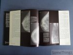 A. Willemin. - Mammographic appearances. / Les images mammographiques. A. Willemin. - Mammographic appearances. / Les images mammographiques.